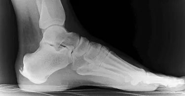 Röntgenbild Haglundextenose