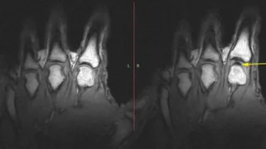 Röntgenbild Hände nach Fingerknacken