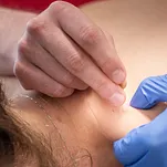 Dry Needling