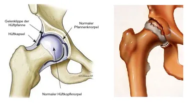 Hüftgelenksprothese
